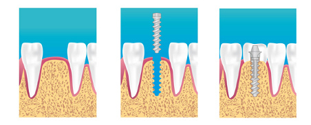 Implant dentaire Sevran 93