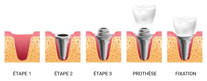 la pose d implant